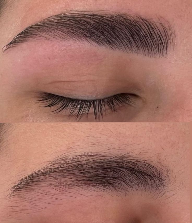 Unibrow laser hair removal